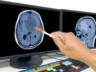 Meningioma.